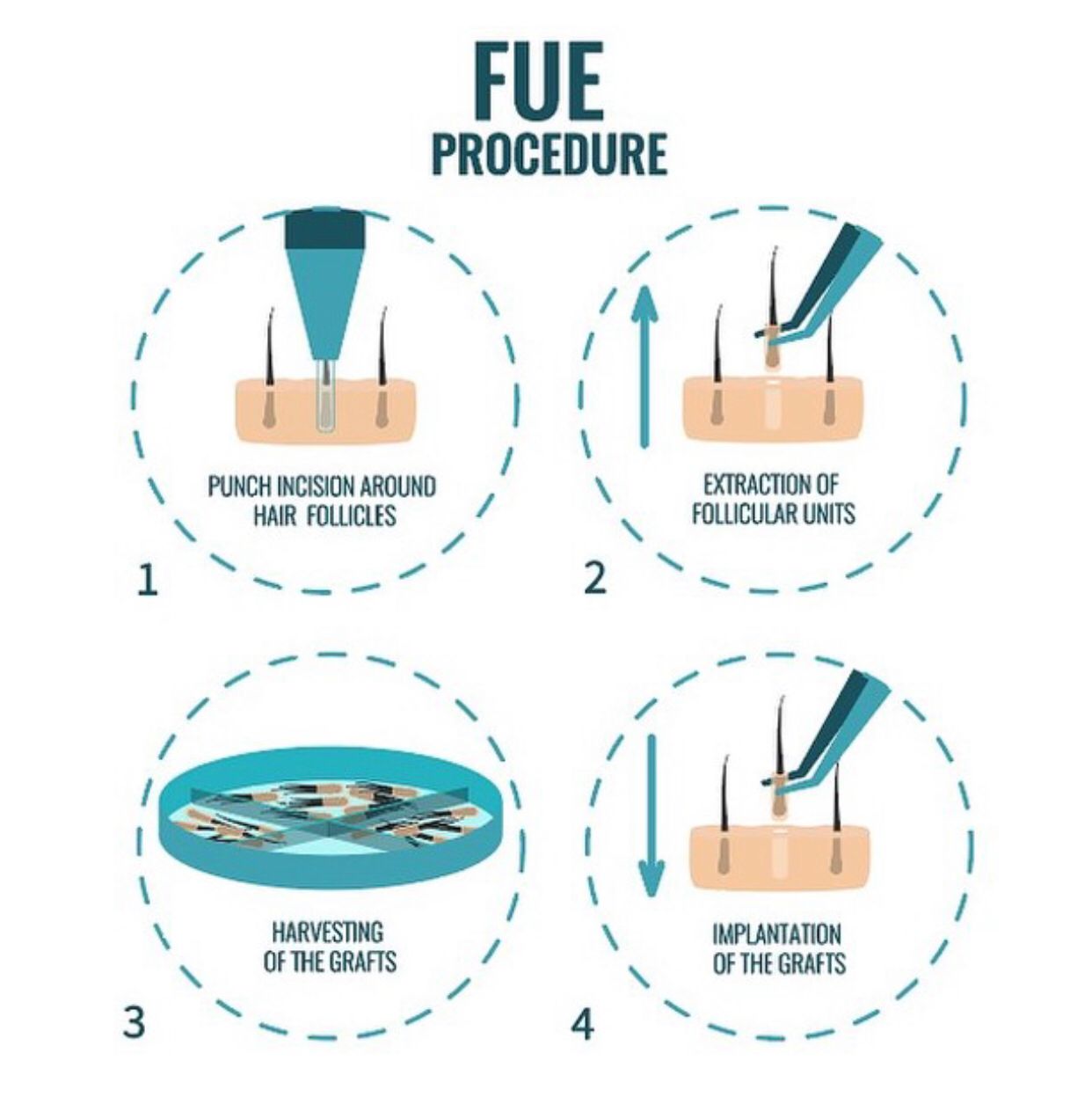 Fue (Follicle Unit Extraction)