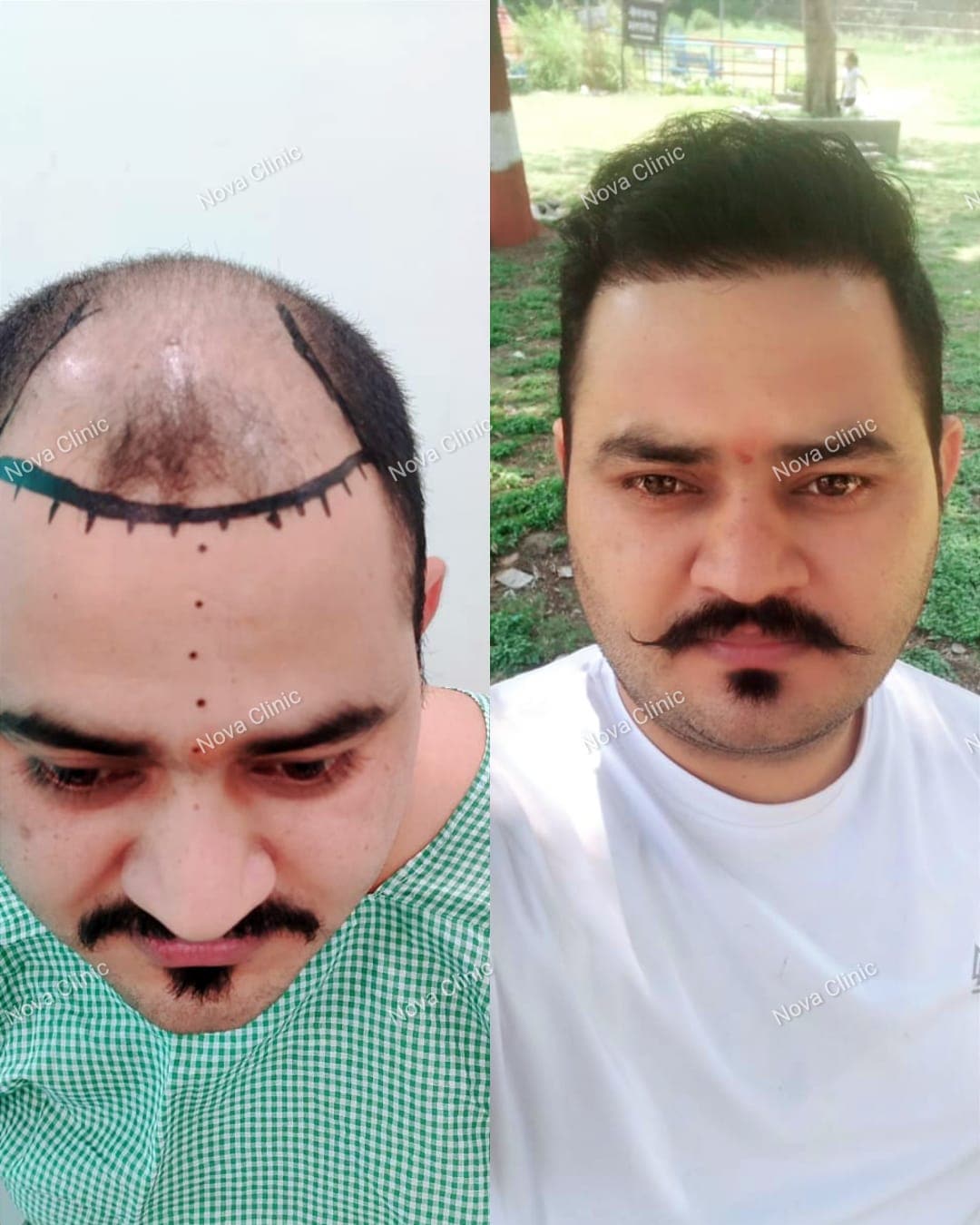 hair specialist doctor in chandigarh Archives  Athena Hair Now