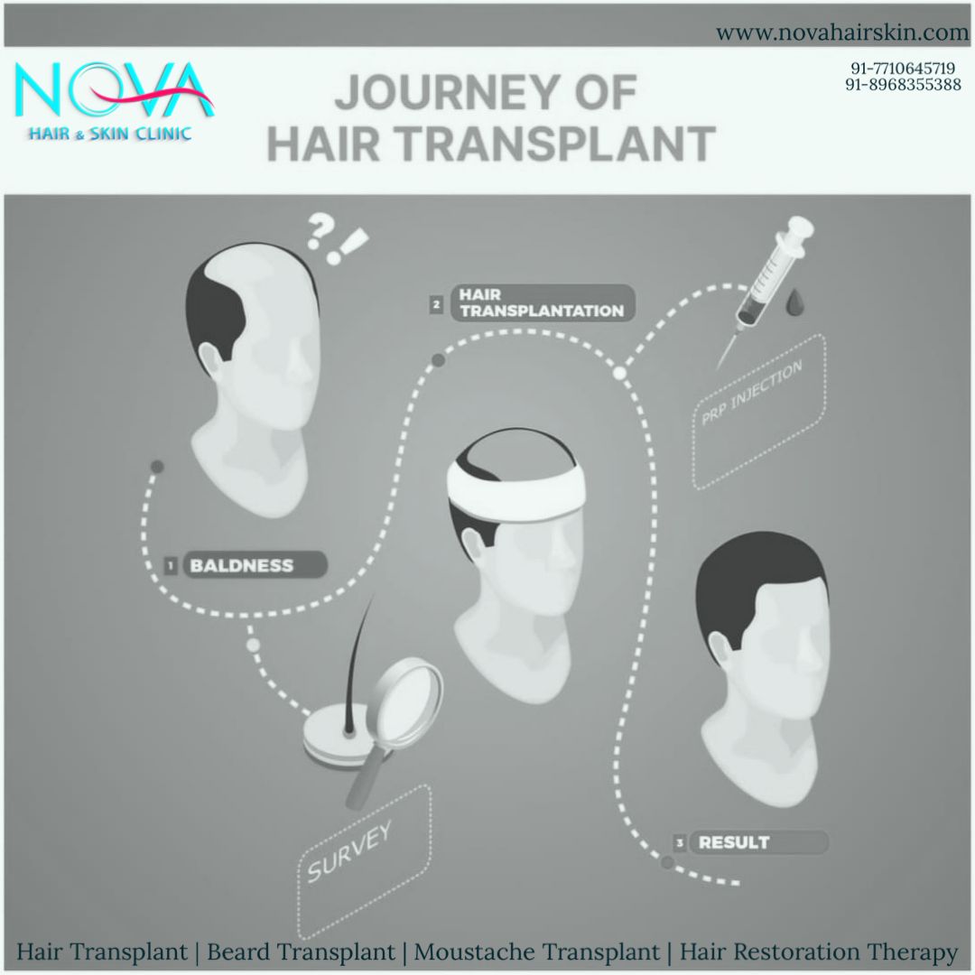 Nova-Hair-Transplant-Clinic