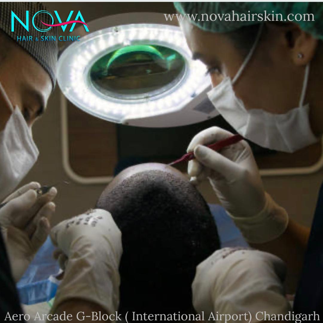 The-Pinnacle-of-Hair-Transplant-Clinics-in-Chandigarh