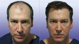 Common-Hair-Transplant-Myths-Separating-Fact-from-Fiction